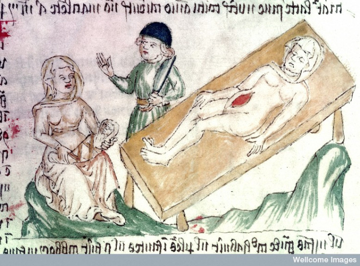 medieval caesarean