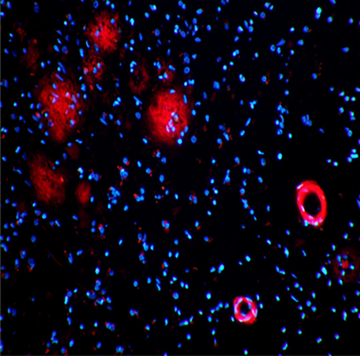 Amyloid plaques