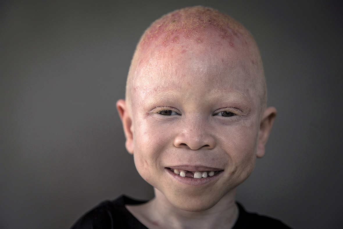 albinos Tanzania witchcraft