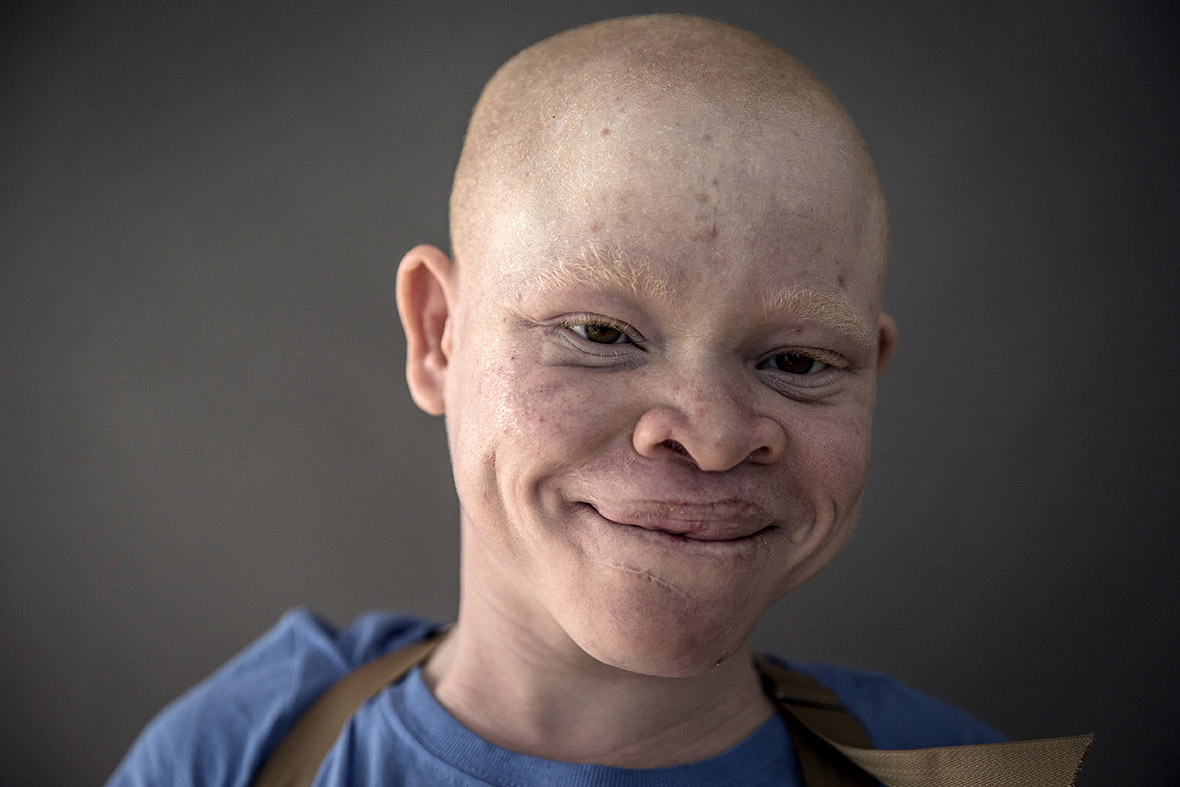 Tanzanian albino children mutilated for witchcraft receive treatment in