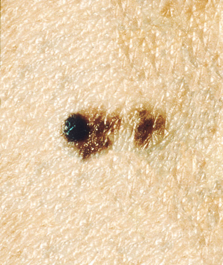 Moles and skin cancer