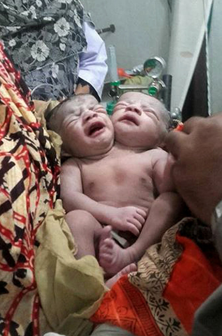 Bangladesh two-headed baby