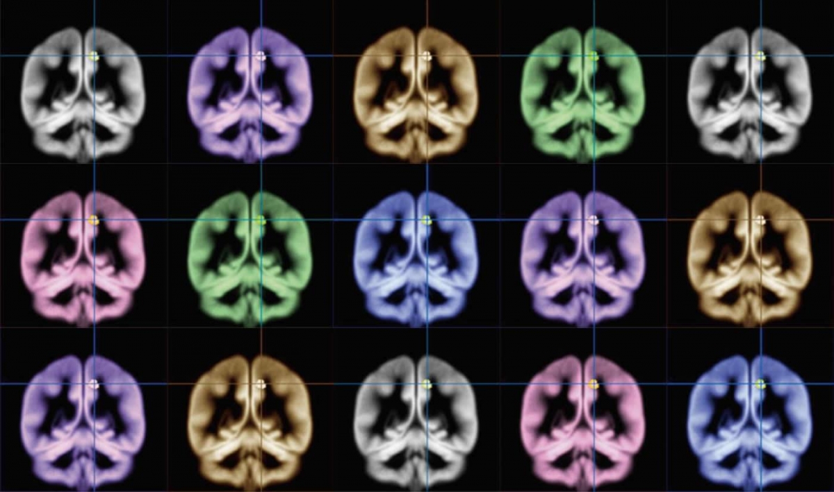 MRI SCANS