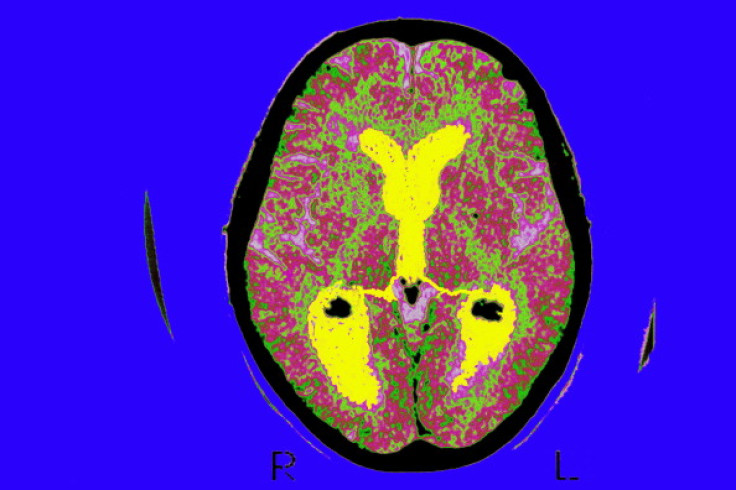 Alzheimer’s brain scan