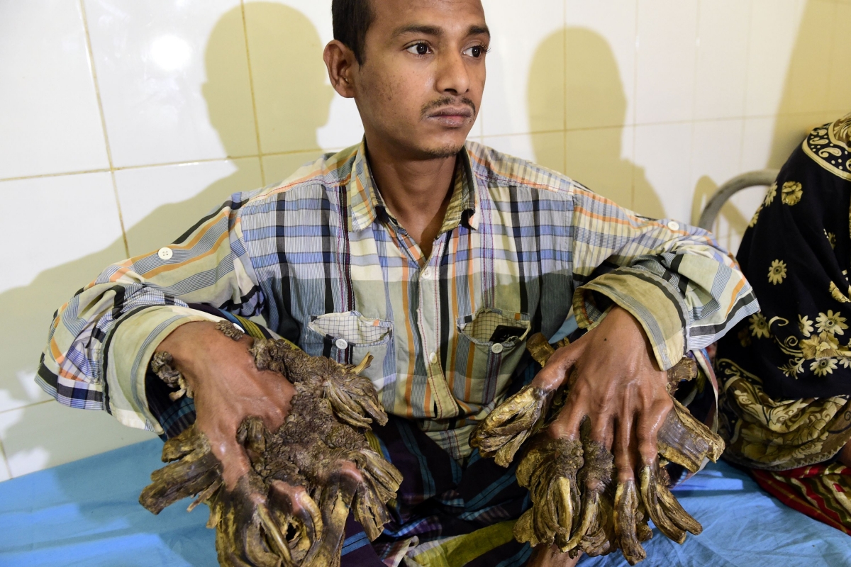 Bangladesh Tree Man With Warts Resembling Tree Growths Finally Ha