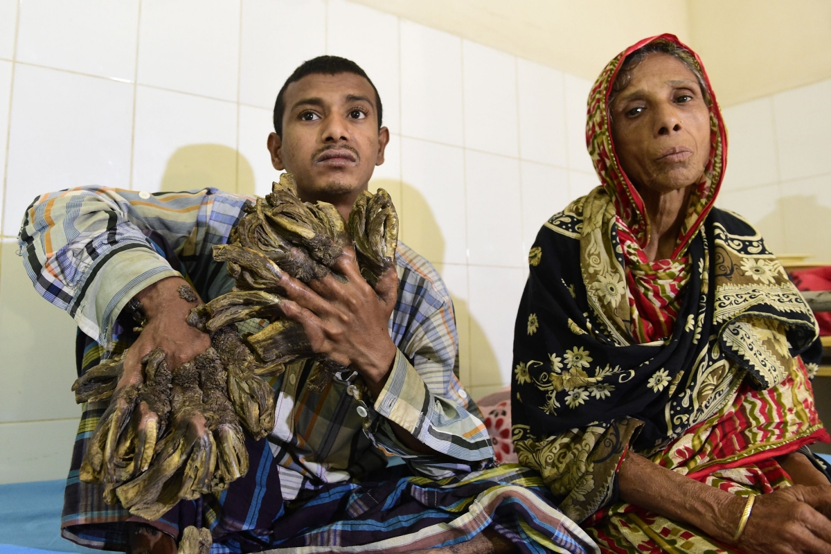 Bangladesh: 'Tree Man' with warts resembling tree growths finally has ...