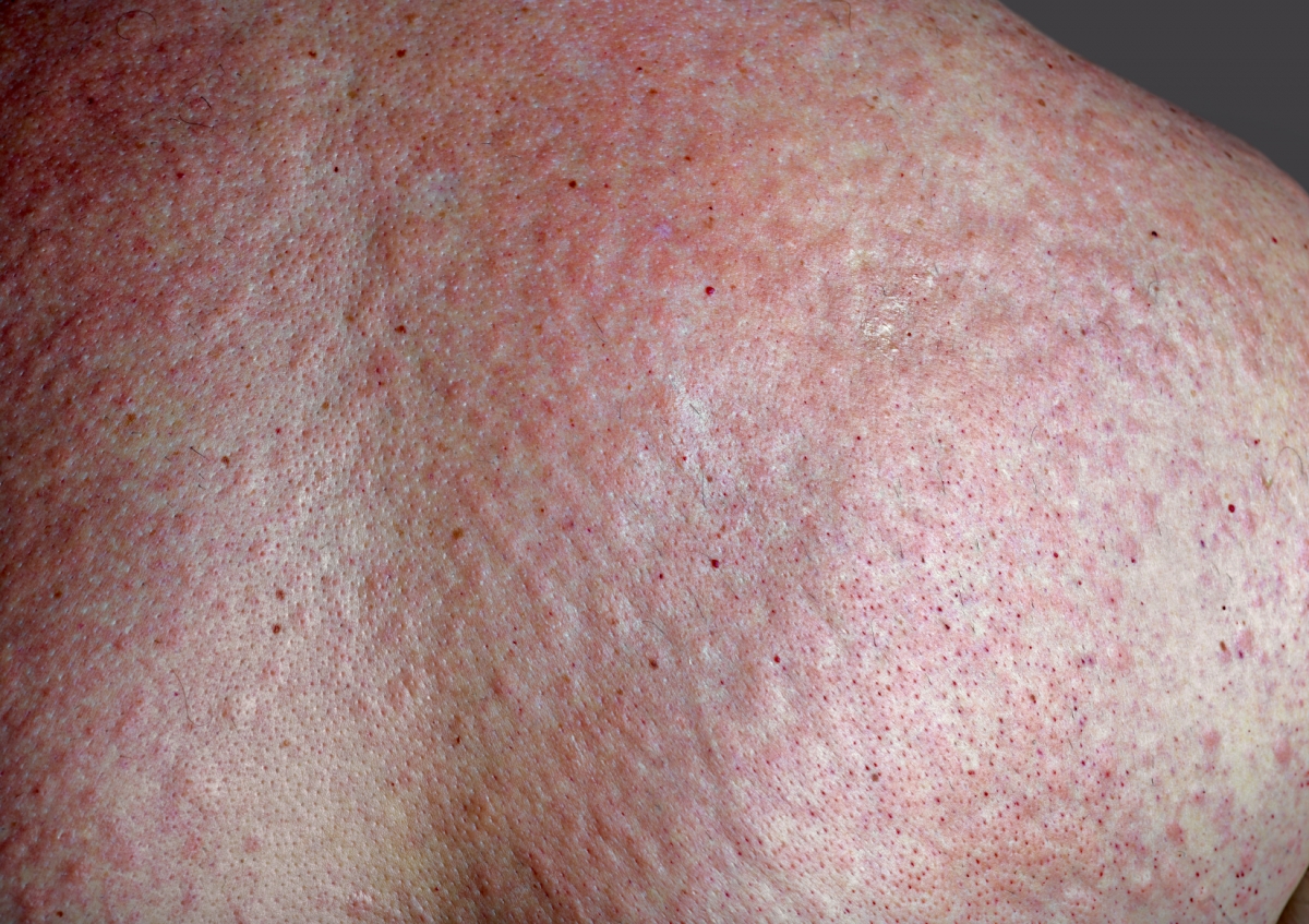 Vibratory Urticarial Rare Disorder Makes People Break Out In Hives 