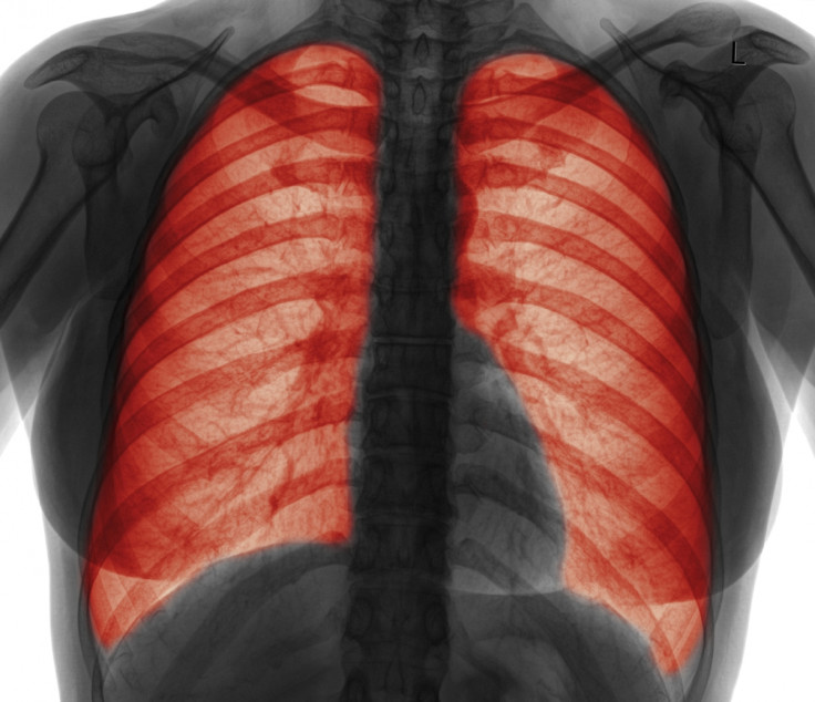 Emphysema