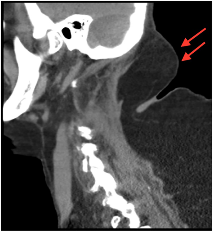 Madelung Disease