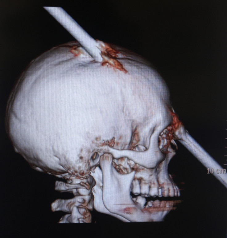 rod through skull