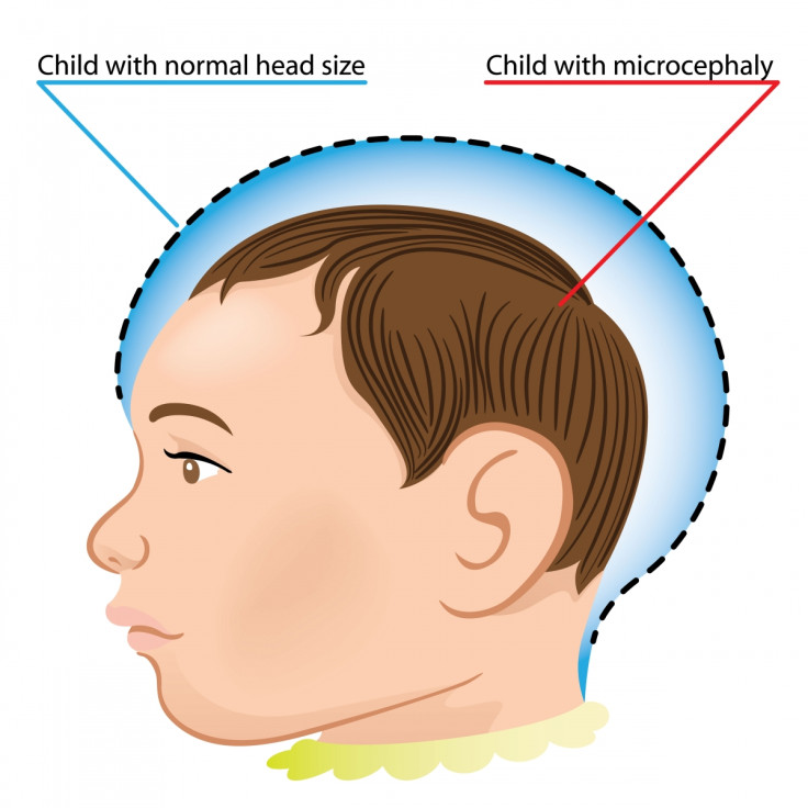 Microcephaly baby heads