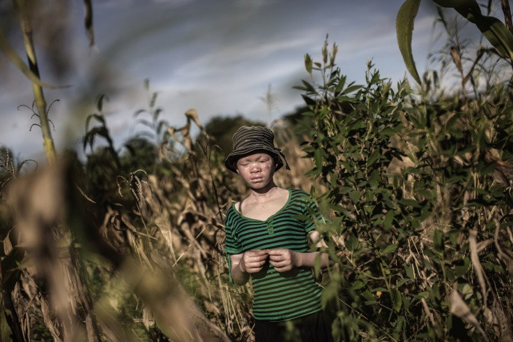 Albinism in Malawi