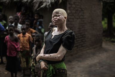 Albinos in Malawi