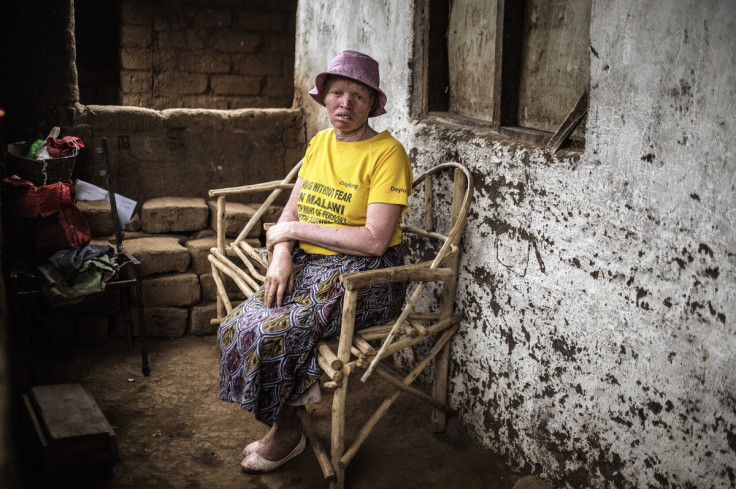 Albinos in Malawi