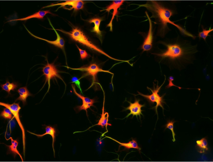 glioma tumour humans