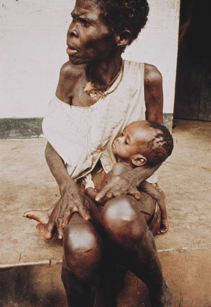 Starvation during 1967-1970 Biafran war