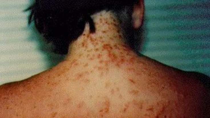 Outbreak of sea lice in Florida