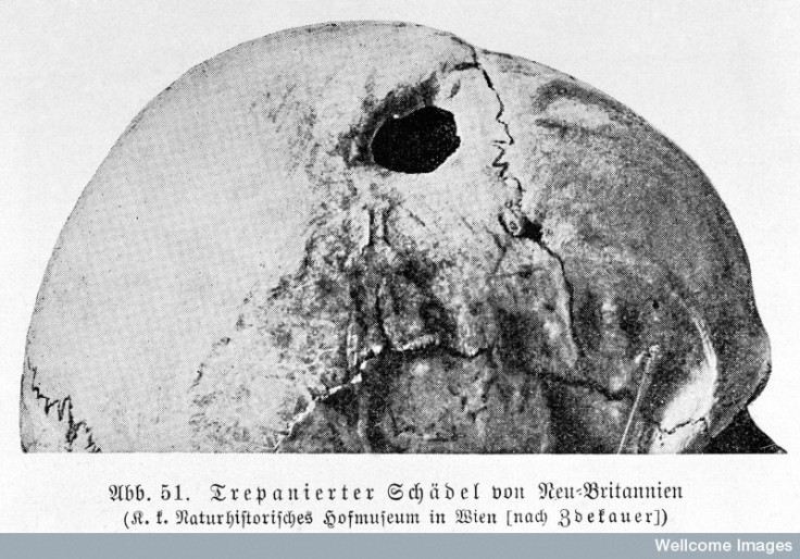 trepanation skull brain