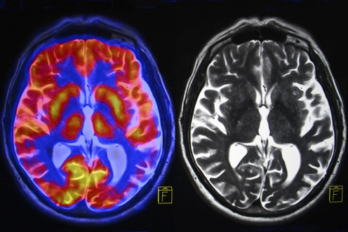 MRI scan showing blood flow in brain