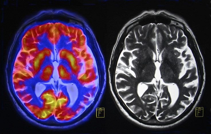 MRI scan showing blood flow in brain