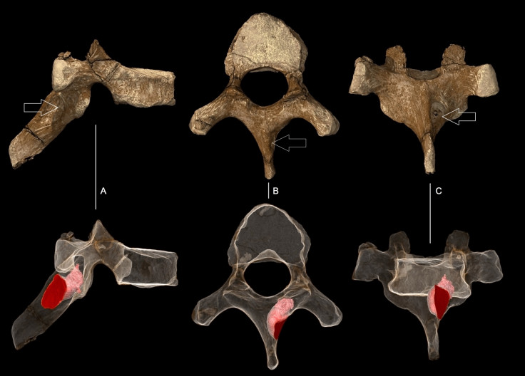 ancient cancer case