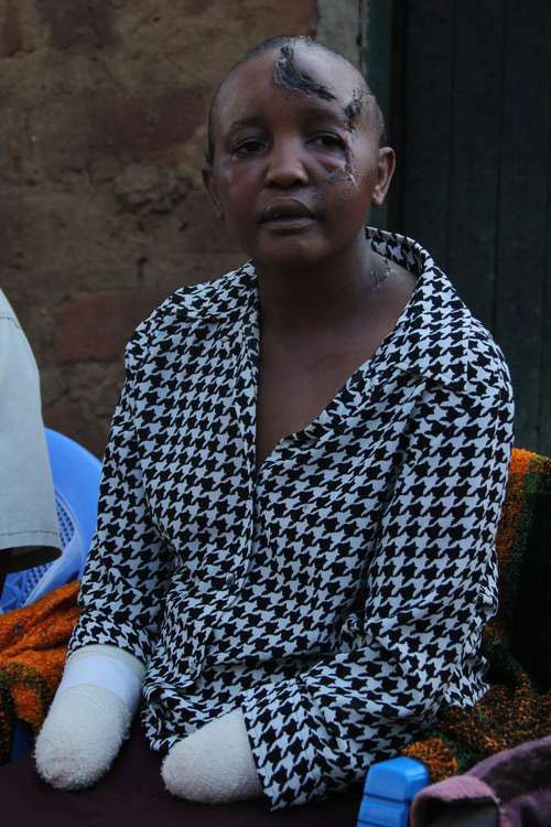 Kenyan Man Chops Off Wife Jackline Mwende S Hands For Not Getting Pregnant