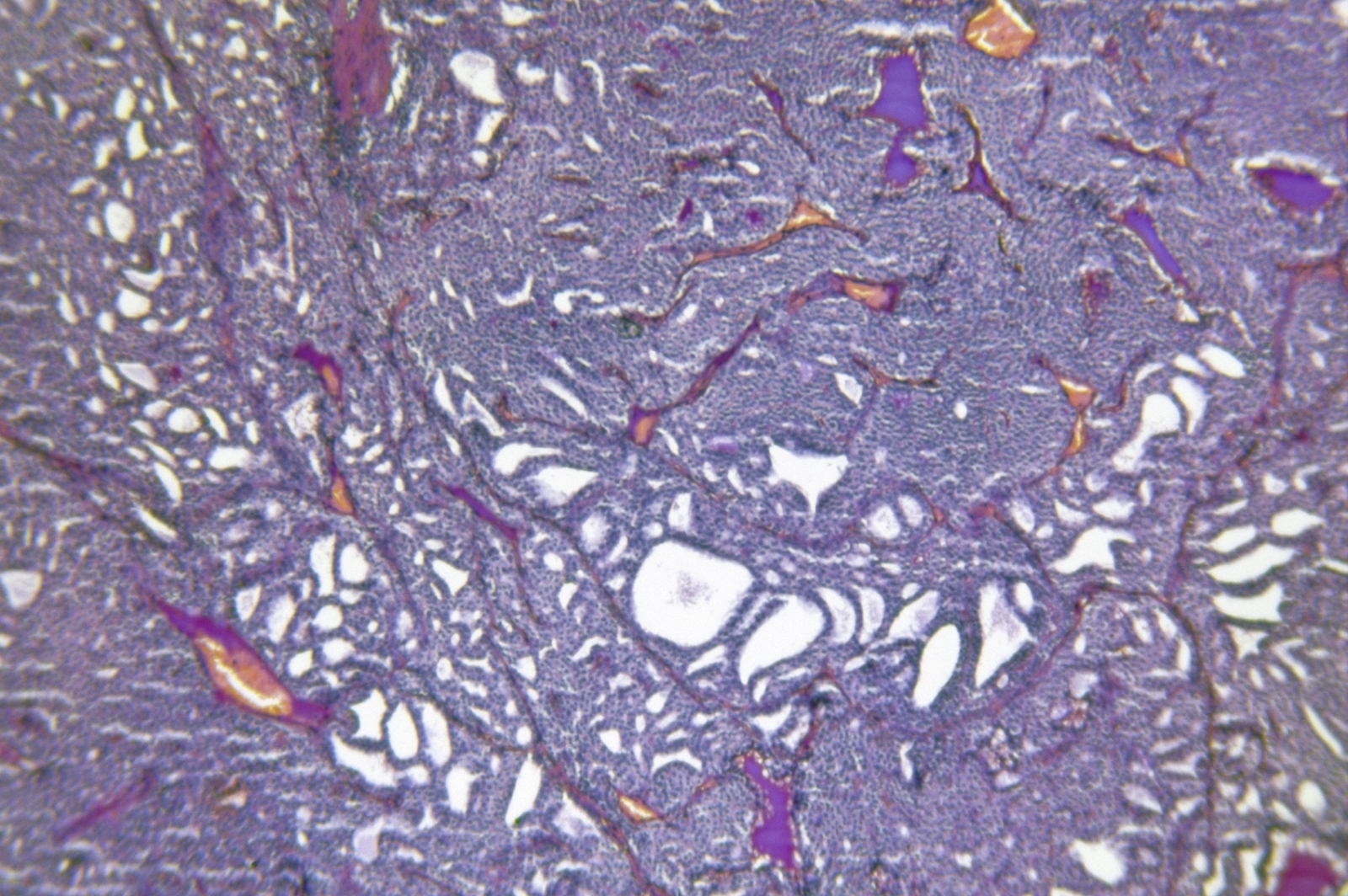 Гиперплазия щитовидной железы под микроскопом