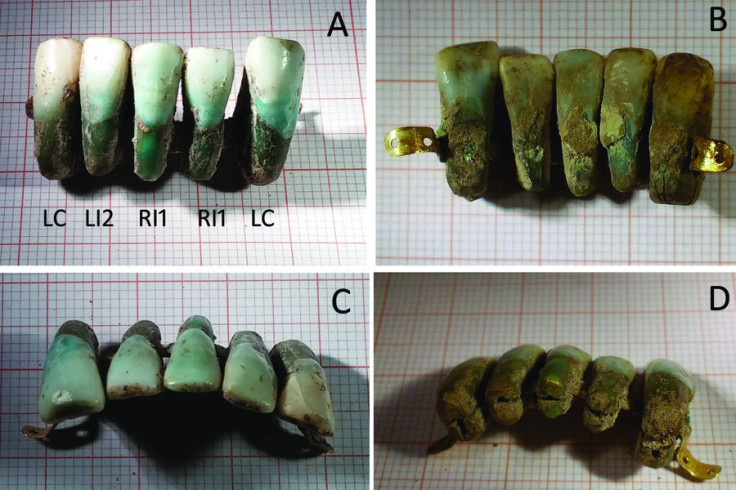 earliest dental prosthesis