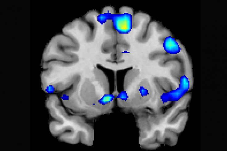 fMRI scan