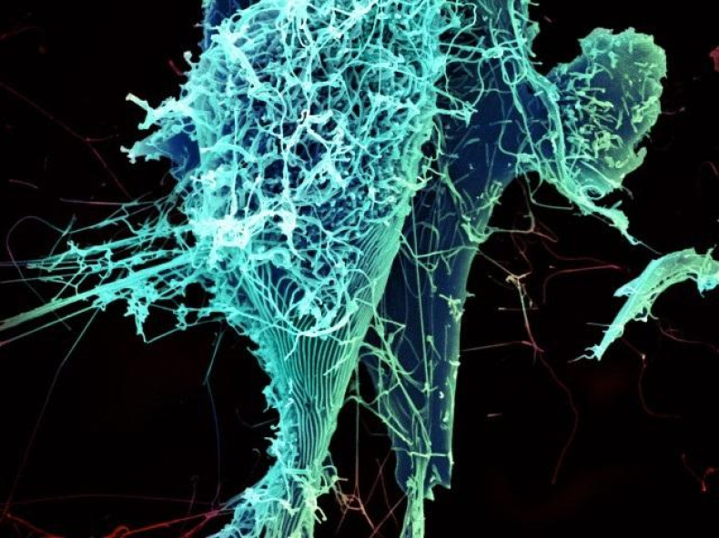Ebola lung infection