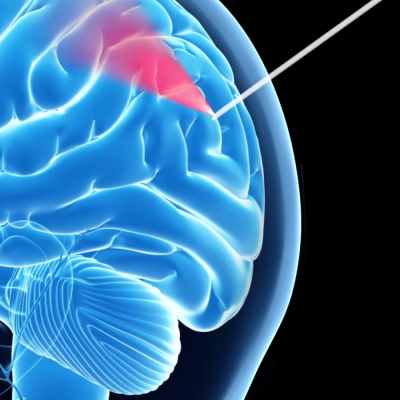 Brain Surgery smart needle