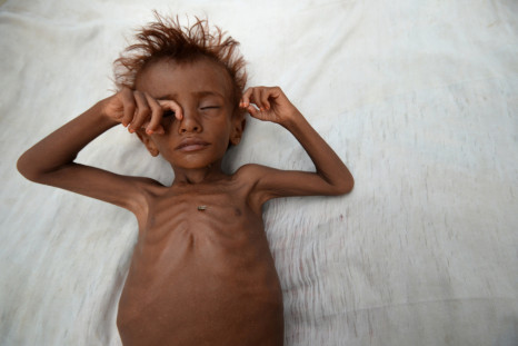 A malnourished boy
