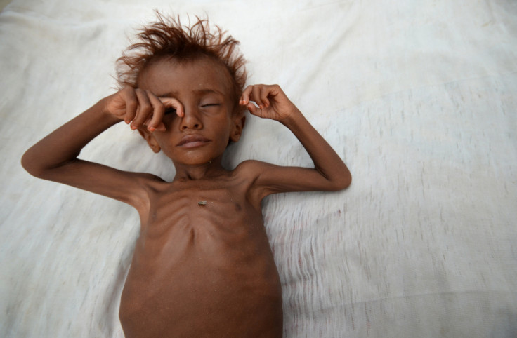 A malnourished boy