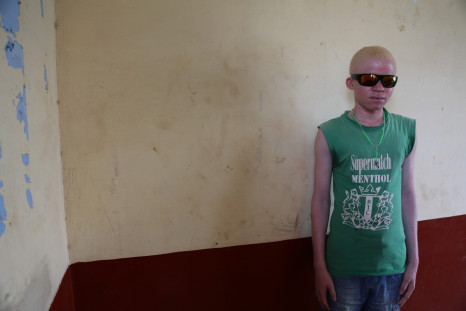 Young Burundian albino