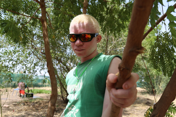 Young Burundian albino