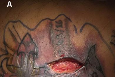 tattoo sepsis