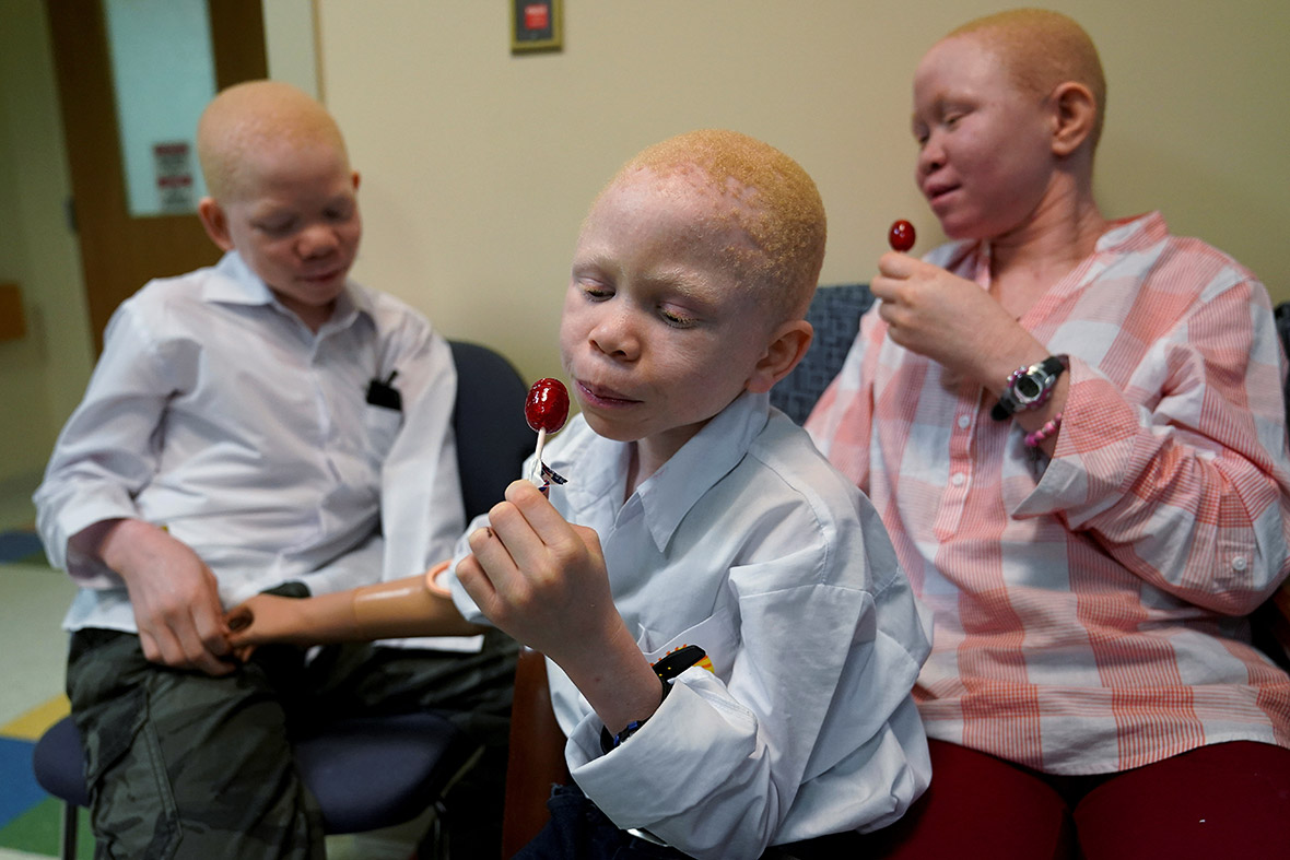 Albino Tanzania witchdoctors prosthetic limbs