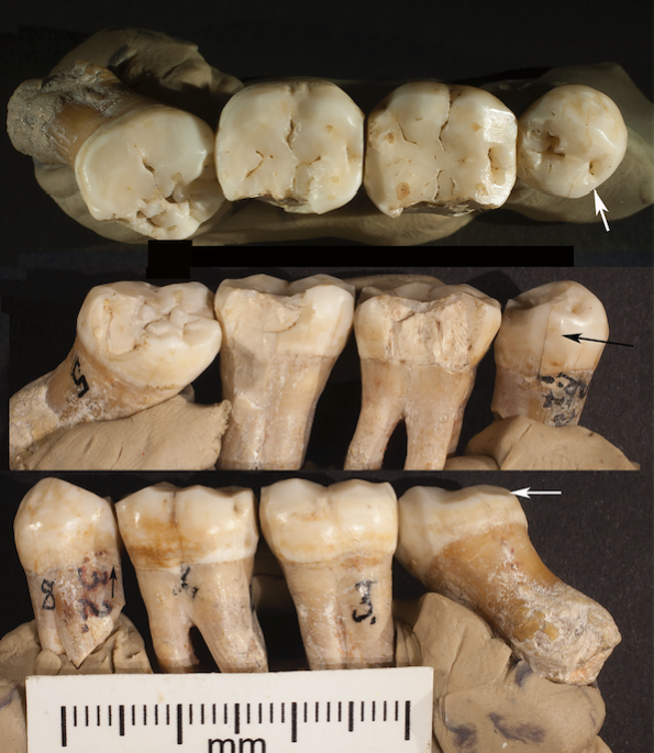 neanderthal dentistry