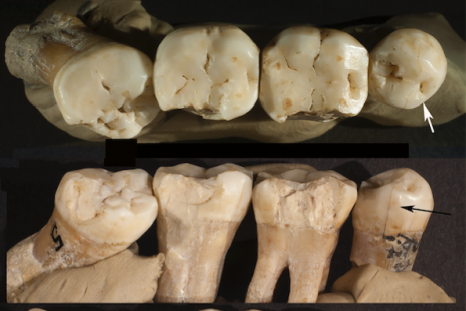 neanderthal dentistry