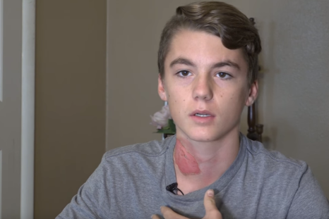 Boy suffers burns in hot water challenge