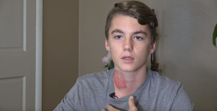 Boy suffers burns in hot water challenge
