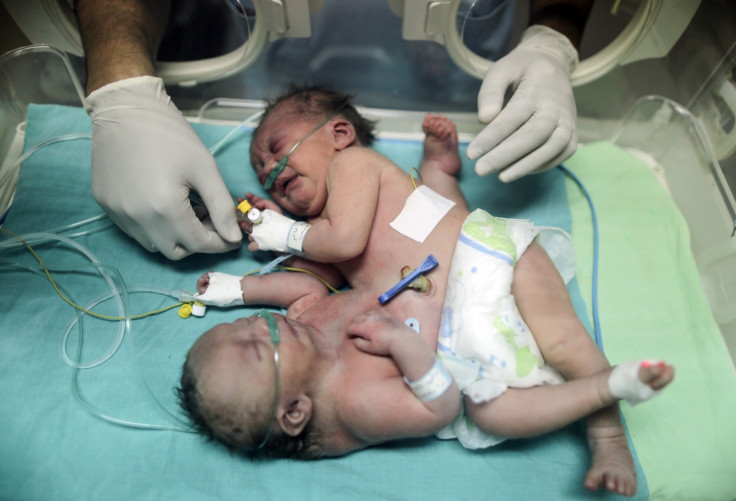 Conjoined twins in Gaza 