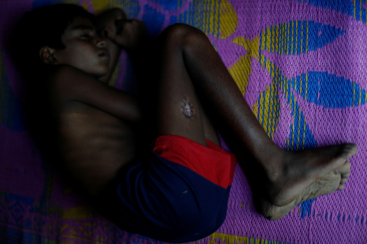 Rohingya Muslim refugee injuries