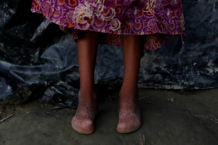 Rohingya Muslim refugee injuries