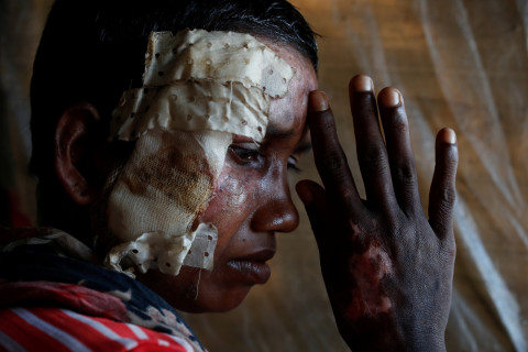 Rohingya Muslim refugee injuries