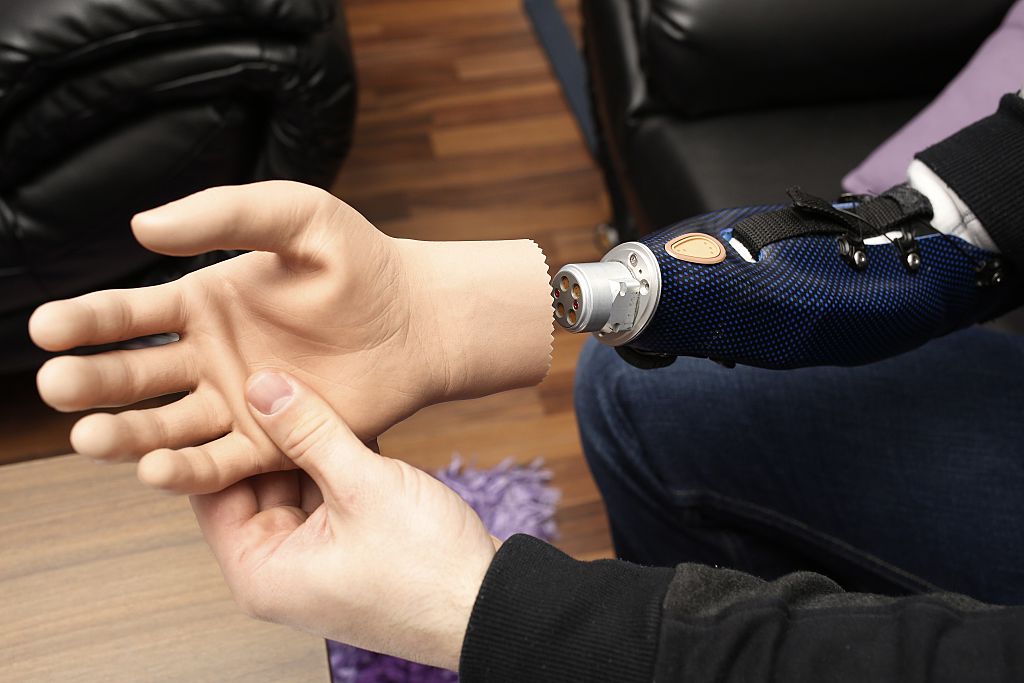 Revolutionary bionic hand brings back woman's ability to