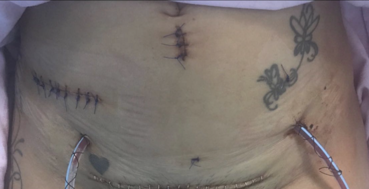 Carla Cressy's surgery wounds 