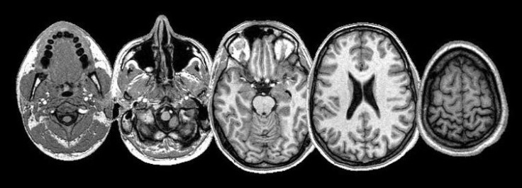 Skull MRI