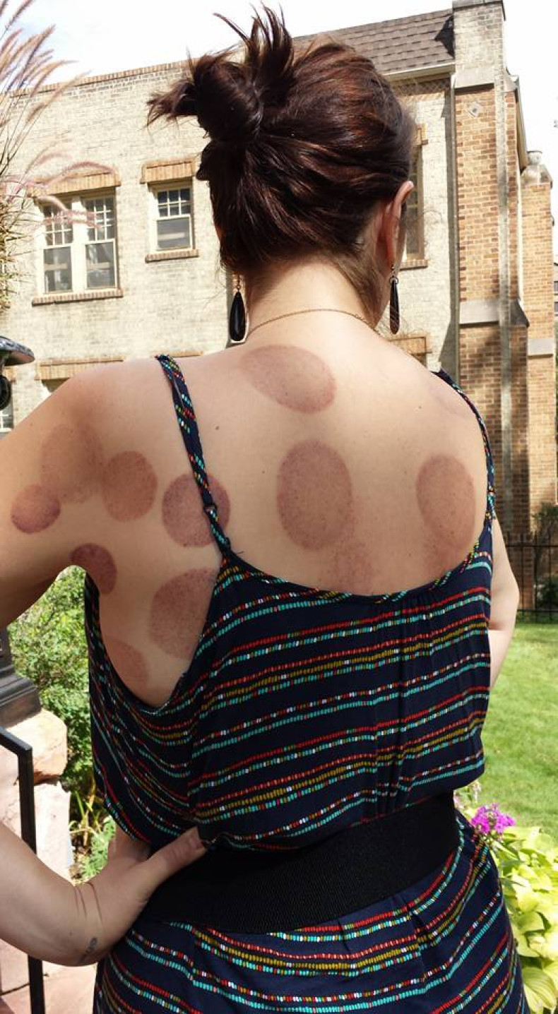 Marks from cannabis-infused cupping