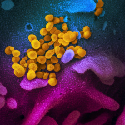 A microscopic image of SARS-CoV-2 in yellow